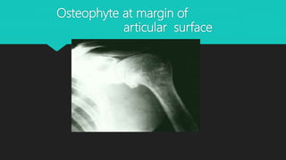 Osteophyte at margin of
articular surface
 