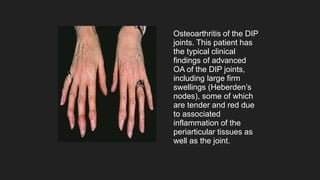 Osteoarthritis of the DIP
joints. This patient has
the typical clinical
findings of advanced
OA of the DIP joints,
including large firm
swellings (Heberden’s
nodes), some of which
are tender and red due
to associated
inflammation of the
periarticular tissues as
well as the joint.
 