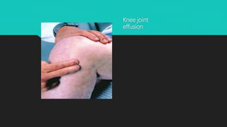 Knee joint
effusion
 
