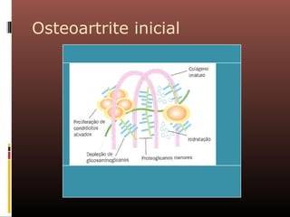 Osteoartrite inicial
 
