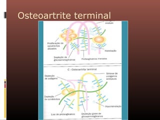 Osteoartrite terminal
 