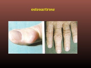 osteoartrose
 