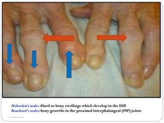 OA for undergraduates: diagnosis & treatment. | PDF