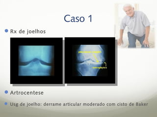 Caso 1
 Rx de joelhos




 Artrocentese
 Usg de joelho: derrame articular moderado com cisto de Baker
 