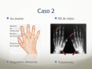 Caso 2
 Ao exame:                       RX de mãos:




 Diagnóstico diferencial         Tratamento
 