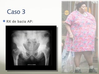 Caso 3
 RX de bacia AP:
 