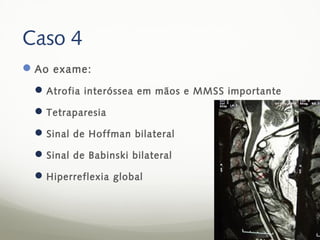 Caso 4
 Ao exame:
  Atrofia interóssea em mãos e MMSS importante
  Tetraparesia
  Sinal de Hoffman bilateral
  Sinal de Babinski bilateral
  Hiperreflexia global
 