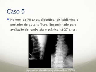 Caso 5
 Homem de 70 anos, diabético, dislipidêmico e
  portador de gota tofácea. Encaminhado para
  avaliação de lombalgia mecânica há 27 anos.




            Hiperostose idiopática esquelética difusa (DISH)
 