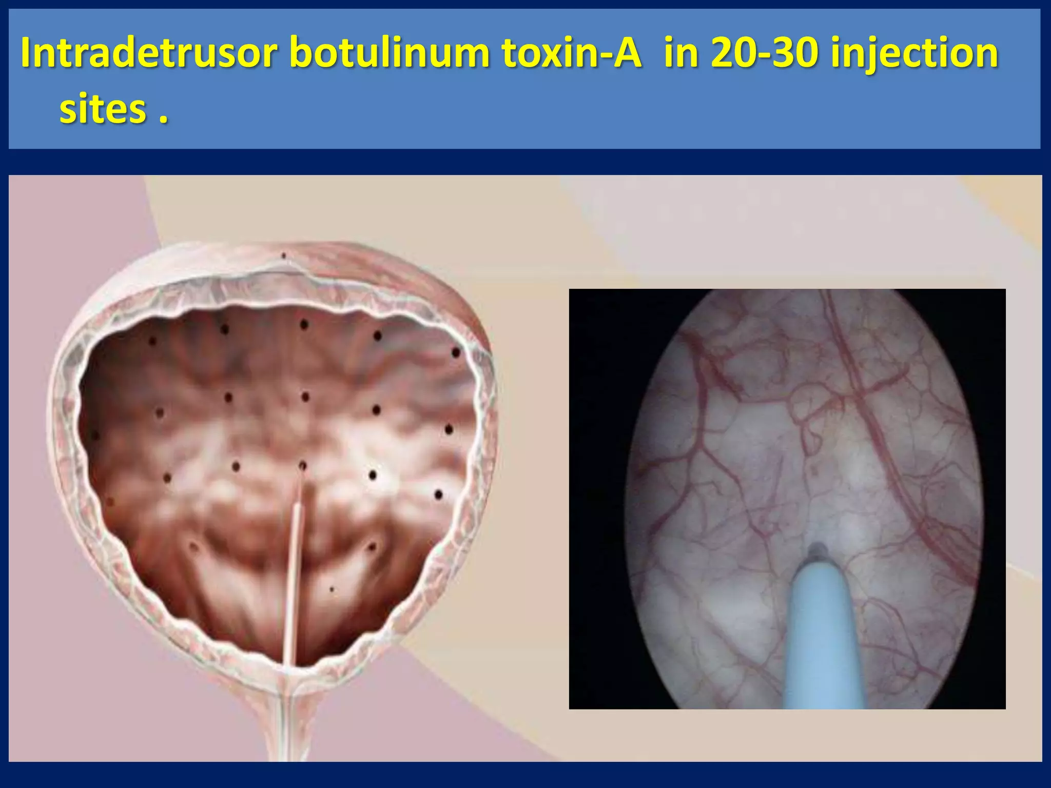 Intradetrusor botulinum toxin-A in 20-30 injection
sites .
 