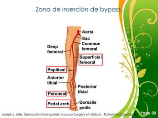 Zona de inserción de bypass.




                                        Free Powerpoint Templates
Joseph L. Mills. Derivación infrainguinal. Vascular Surgery 6th Edición. Rutherford.Capítulo 81.   Page 30
 