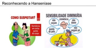 Reconhecendo a Hanseníase
 