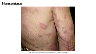 http://www.atlasdermatologico.com.br/disease.jsf?diseaseId=231
Hanseníase
 