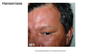 http://www.atlasdermatologico.com.br/disease.jsf?diseaseId=231
Hanseníase
 