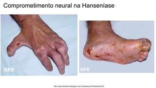 http://www.atlasdermatologico.com.br/disease.jsf?diseaseId=234
Comprometimento neural na Hanseníase
 