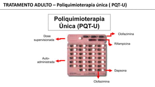TRATAMENTO ADULTO – Poliquimioterapia única ( PQT-U)
Poliquimioterapia
Única (PQT-U)
Auto-
administrada
Dose
supervisionada
Clofazimina
Clofazimina
Rifampicina
Dapsona
 