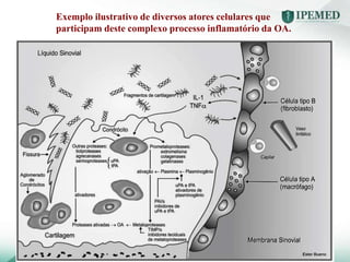 Exemplo ilustrativo de diversos atores celulares que
participam deste complexo processo inflamatório da OA.
 