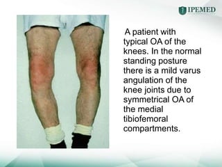 A patient with
typical OA of the
knees. In the normal
standing posture
there is a mild varus
angulation of the
knee joints due to
symmetrical OA of
the medial
tibiofemoral
compartments.
 