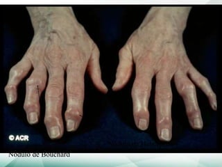 Nódulo de Bouchard
Nódulo de Heberden
 