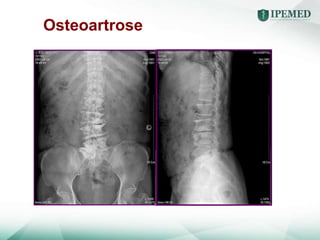 Osteoartrose
 