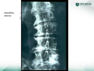 Osteófitos
laterais
 