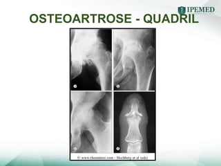 OSTEOARTROSE - QUADRIL
 