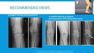 Osteoarthritis knee- introduction and approach | PPTX