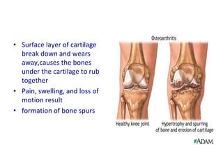• Surface layer of cartilage
break down and wears
away,causes the bones
under the cartilage to rub
together
• Pain, swelling, and loss of
motion result
• formation of bone spurs
 