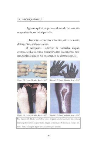 75
2.1.12 - DOENÇAS DA PELE
Agentes químicos provocadores de dermatoses
ocupacionais, os principais são:
1. Irritantes - cimento, solventes, óleos de corte,
detergentes, ácidos e álcalis.
2. Alérgenos - aditivos da borracha, níquel,
cromo e cobalto como contaminantes do cimento, resi-
nas, tópicos usados no tratamento de dermatoses. (3)
Nas figuras 2.1, 2.2, 2.3 e 2.4 observamos respectivamente: dermatite de contato;
micropapuloeritematosas; dermatite alérgica cronificada e dermatite de contato irri-
tativa forte. Todas por algum tipo de contato por cimento.
 