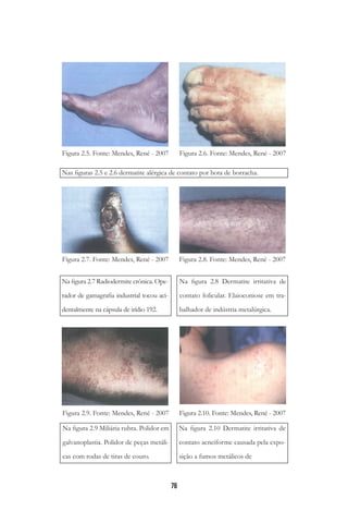 76
Nas figuras 2.5 e 2.6 dermatite alérgica de contato por bota de borracha.
 