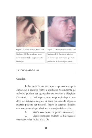 77
2.1.3 DOENÇAS DO OLHO
Ceratite
Inflamação da córnea, aquelas provocadas pela
exposição a agentes físicos e químicos no ambiente de
trabalho podem ser agrupadas em tóxicas e alérgicas.
O arsênico e o berílio podem ser responsáveis por qua-
dros de natureza alérgica. A seiva ou suco de algumas
plantas podem ser tóxicos. Entre os agentes listados
como capazes de produzir ceratoconjuntivite estão:
1.	 Arsênico e seus compostos arsenicais;
2.	 Ácido sulfídrico (sulfeto de hidrogênio)
em exposições muito altas. (8)
 