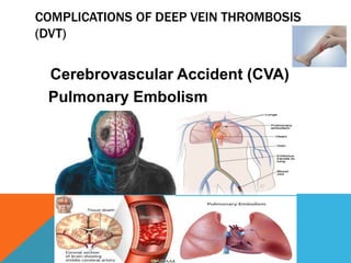 COMPLICATIONS OF DEEP VEIN THROMBOSIS
(DVT)
Cerebrovascular Accident (CVA)
Pulmonary Embolism
 