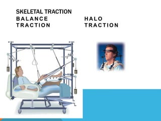 SKELETAL TRACTION
B A L A N C E
T R A C T I O N
H A L O
T R A C T I O N
 