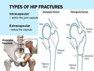 TYPES OF HIP FRACTURES
Intracapsular
 within the joint capsule
Extracapsular
 below the capsule
 
