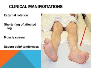 External rotation
Shortening of affected
leg
Muscle spasm
Severe pain/ tenderness
CLINICAL MANIFESTATIONS
 
