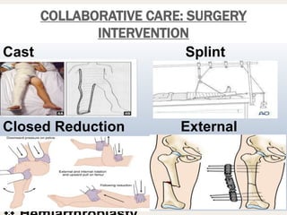 Cast Splint
Closed Reduction External
Fixation
Open Reduction Internal Fixation
(ORIF)
COLLABORATIVE CARE: SURGERY
INTERVENTION
 
