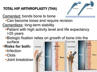 Cemented: bonds bone to bone
Can become loose and require revision
Cementless: long-term stability
Patient with high activity level and life expectancy
>25 years
Biologic fixation relies on growth of bone into the
surface
Risks for both:
Infection
Clots
Joint breakdown
TOTAL HIP ARTHROPLASTY (THA)
 