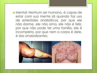  Mental:

Nenhum ser humano, é capaz de
estar com sua mente sã quando faz uso
de esteróides anabólicos, por que ele
não dorme, ele não ama, ele não é feliz,
por que não pode ter uma família, ele é
incompleto, por que nem o corpo é dele,
é dos anabolizantes.

 
