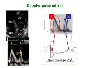 Doppler pulsé mitral
 