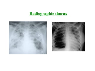 Radiographie thorax
 