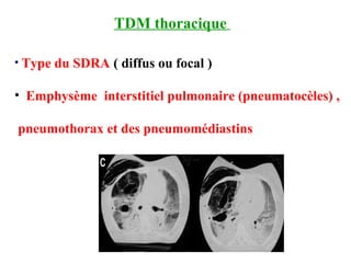 TDM thoracique
• Type du SDRA ( diffus ou focal )
• Emphysème interstitiel pulmonaire (pneumatocèles) ,
pneumothorax et des pneumomédiastins
 