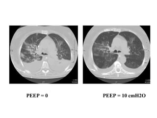 PEEP = 0 PEEP = 10 cmH2O
 