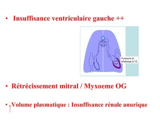 Insuffisance ventriculaire gauche ++ Rétrécissement mitral / Myxoeme OG Volume plasmatique : Insuffisance rénale anurique 