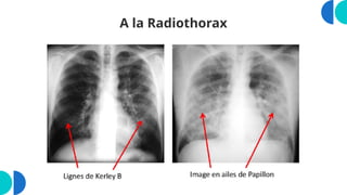 A la Radiothorax
 