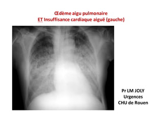 Œdème	aigu	pulmonaire
ET Insuffisance	cardiaque	aiguë	(gauche)
Pr	LM	JOLY
Urgences
CHU	de	Rouen
 