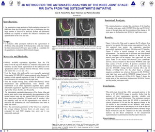 José G. Tamez-Peña, Saara Totterman and Patricia González 3D METHOD FOR THE AUTOMATED ANALYSIS OF THE KNEE JOINT SPACE: MRI DATA FROM THE OSTEOARTHRITIS INITIATIVE Rochester NY ,[object Object],[object Object],[object Object],[object Object],[object Object],[object Object],[object Object],[object Object],[object Object],[object Object],[object Object],[object Object],[object Object],[object Object],[object Object],[object Object],[object Object],[object Object],Figure 3: Top, scatter plot of Baseline Total WOMAC and 3D Medial Joint Space Width (3DMJSW). Middle, Observed Annual Change in 3DMJSW and Total WOMAC. Bottom, Observed change in 3DMJSW between the 12 Month observation and the 18 Month Observation vs. Total WOMAC. Figure 1:  OAI 3D DESS series was used to create a knee atlas. The bones: Femur, tibia and patella were traced and then regions of interest were defined for quantitative analysis of the joint space. Figure 2:  The atlas was tracked to all the subjects. Once the atlas was mapped into each time point. The segmentation was inspected by a train observed. 