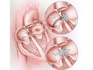 Patent foramen ovale