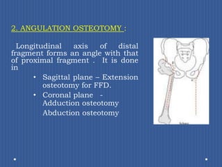 2. ANGULATION OSTEOTOMY :Longitudinal axis of distal fragment forms an angle with that of proximal fragment .  It is done in  Sagittal plane – Extension osteotomy for FFD.Coronal plane 	- Adduction osteotomy    Abduction osteotomy