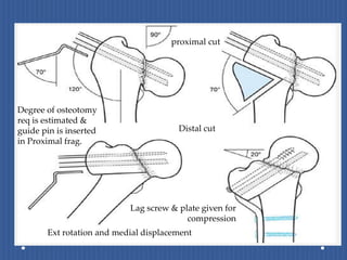 proximal cut	Degree of osteotomy req is estimated & guide pin is inserted in Proximal frag.Distal cutLag screw & plate given for compressionExt rotation and medial displacement