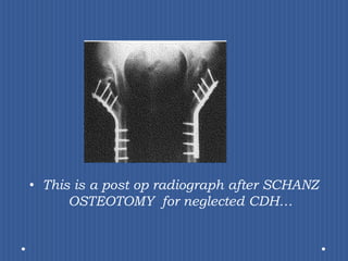 This is a post op radiograph after SCHANZ OSTEOTOMY  for neglected CDH…