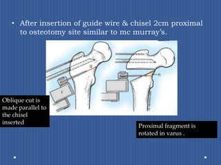 After insertion of guide wire & chisel 2cm proximal to osteotomy site similar to mc murray’s.Oblique cut is made parallel to the chisel insertedProximal fragment is rotated in varus .